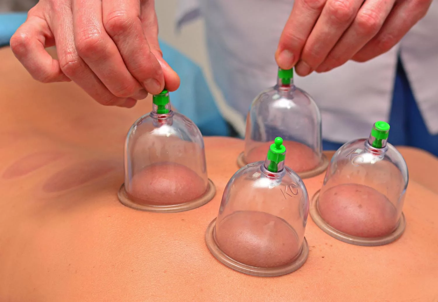 Cupping therapy for muscle recovery, woman removes cups from the patient's back